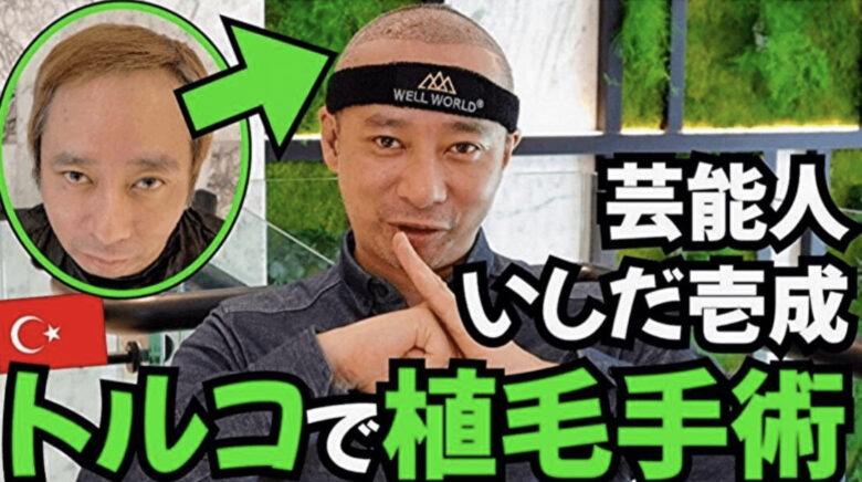 いしだ壱成のハゲ植毛治療